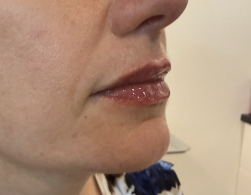 Immediate — lip enhancement