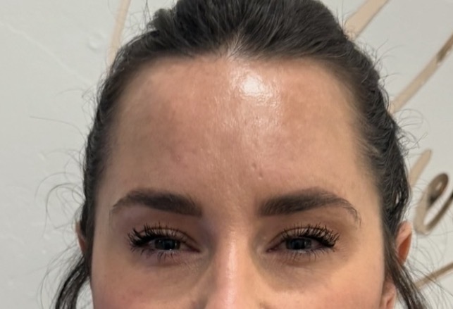 After — lip enhancement