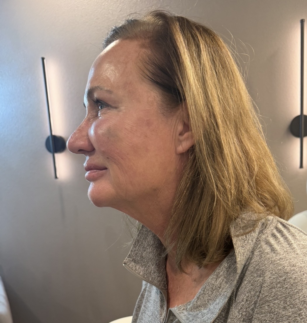 Dermal Filler after — case 3