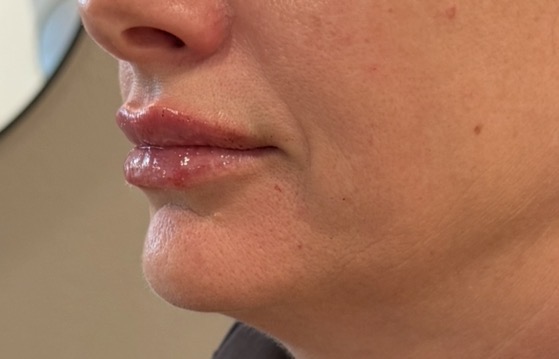 Immediate — lip enhancement