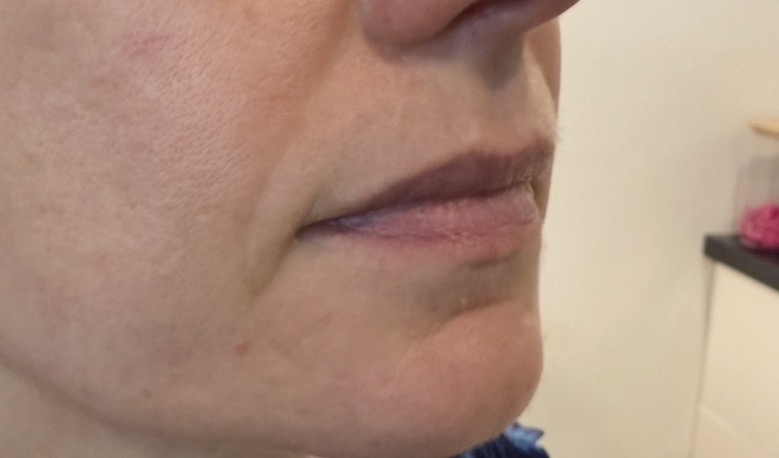 Before — lip enhancement