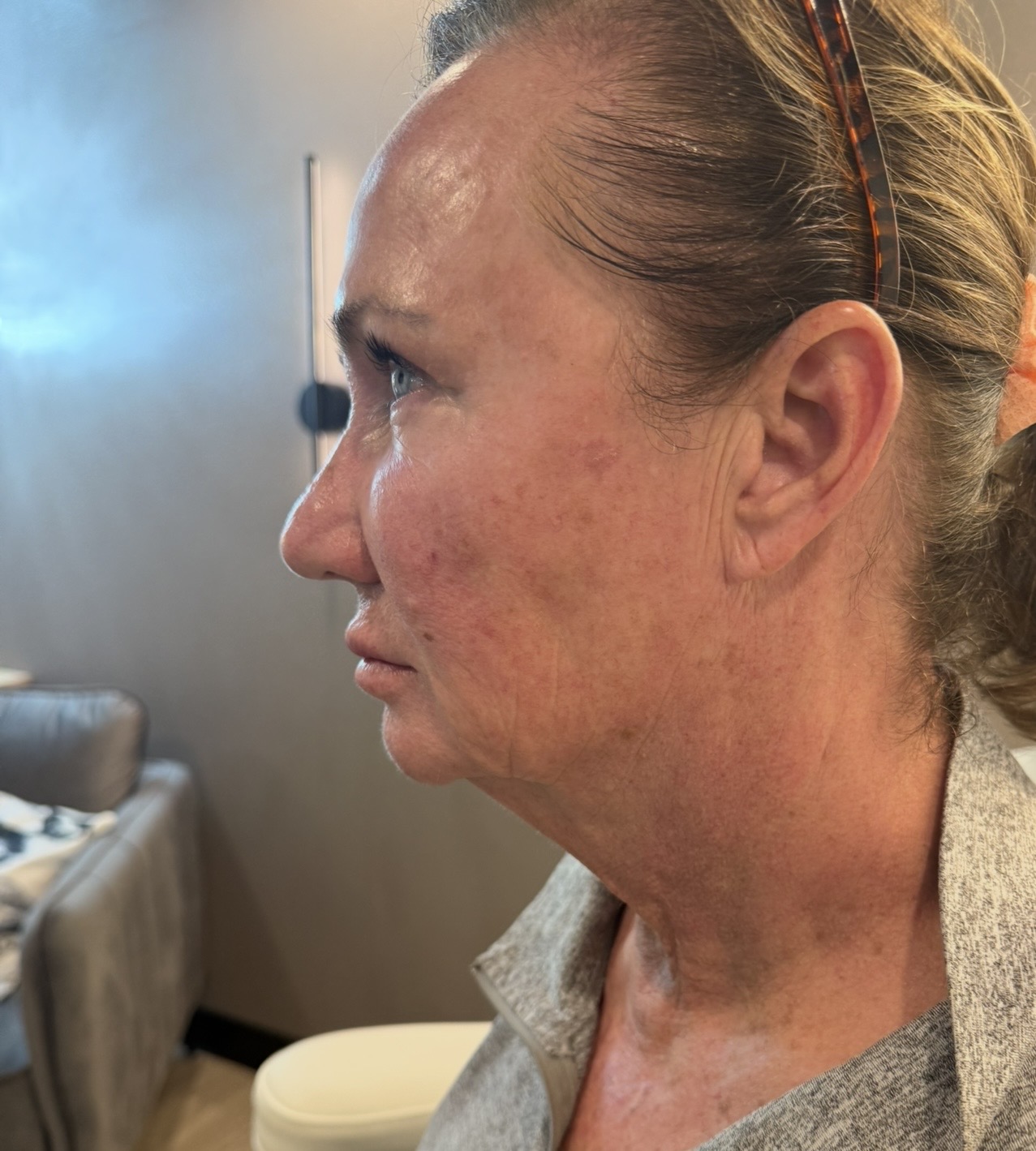 Dermal Filler before — case 3