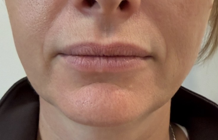 Before — lip enhancement
