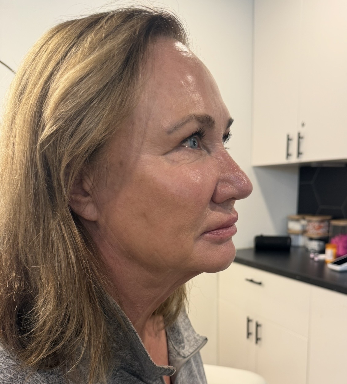 Dermal Filler after — case 2