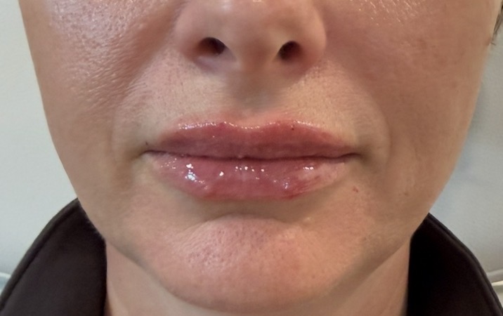 Immediate — lip enhancement