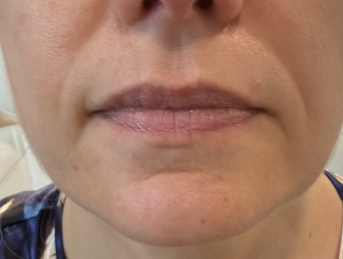 Before — lip enhancement