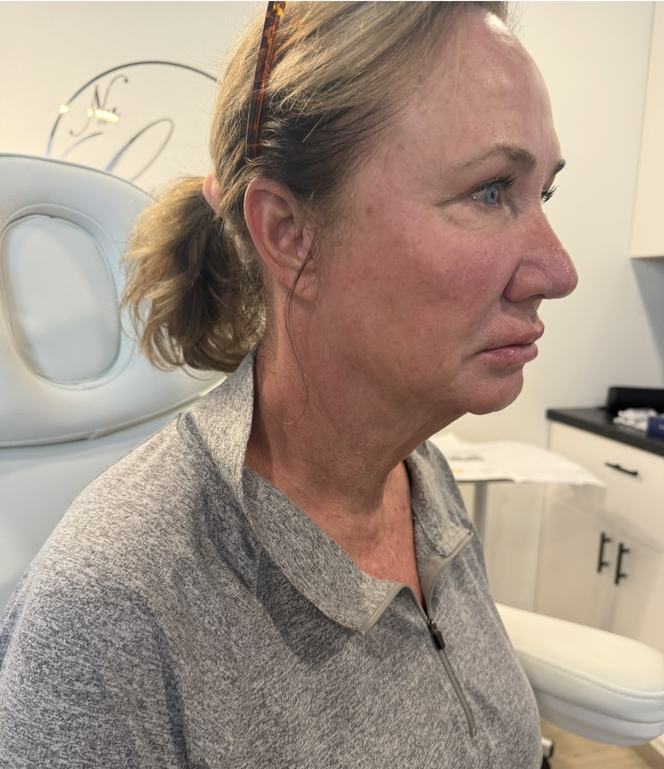 Dermal Filler before — case 2