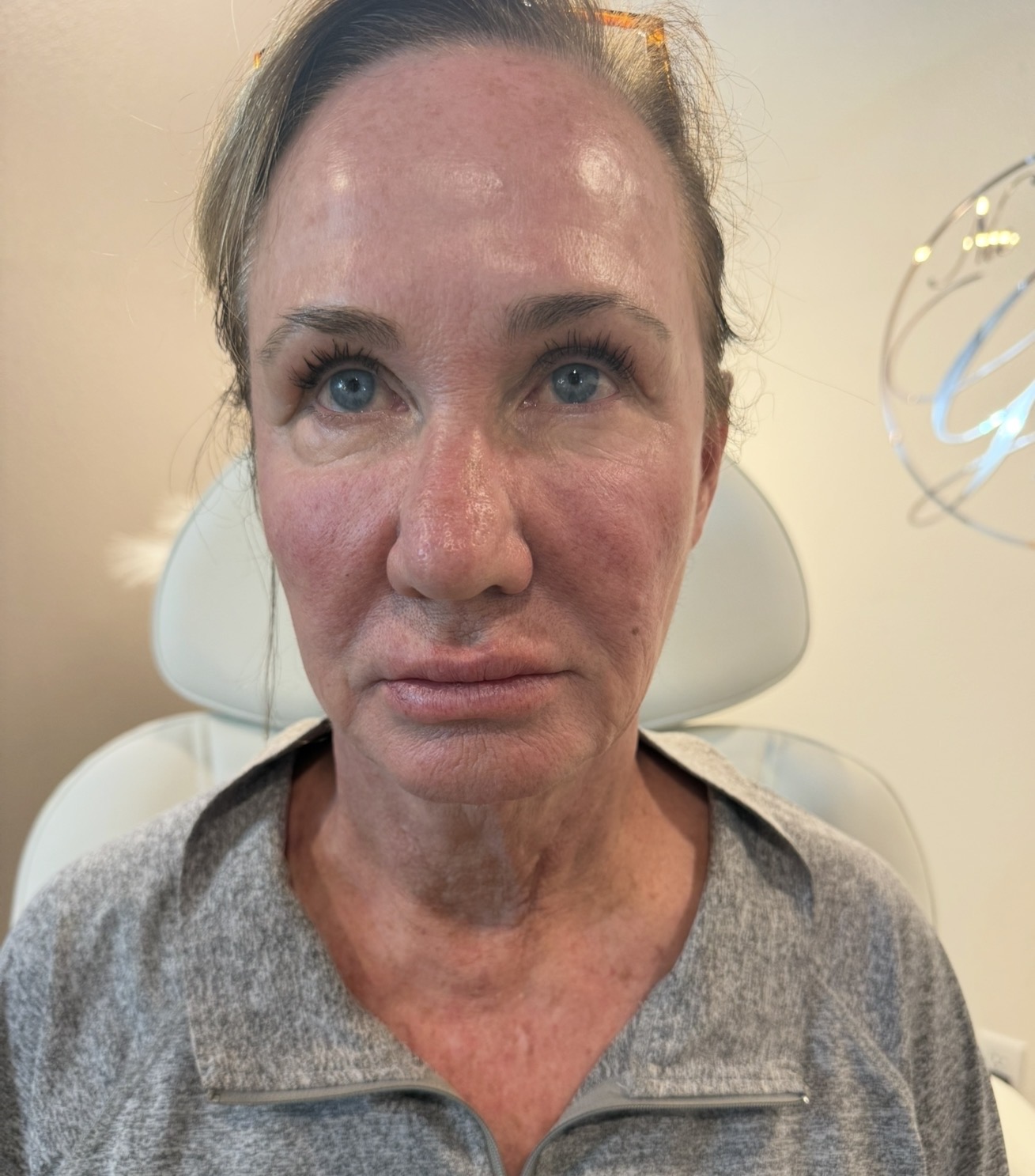 Dermal Filler before — case 1