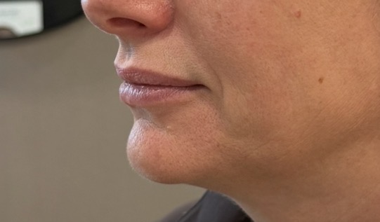 Before — lip enhancement