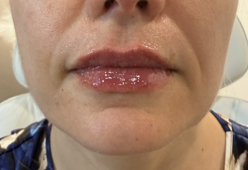 Immediate — lip enhancement