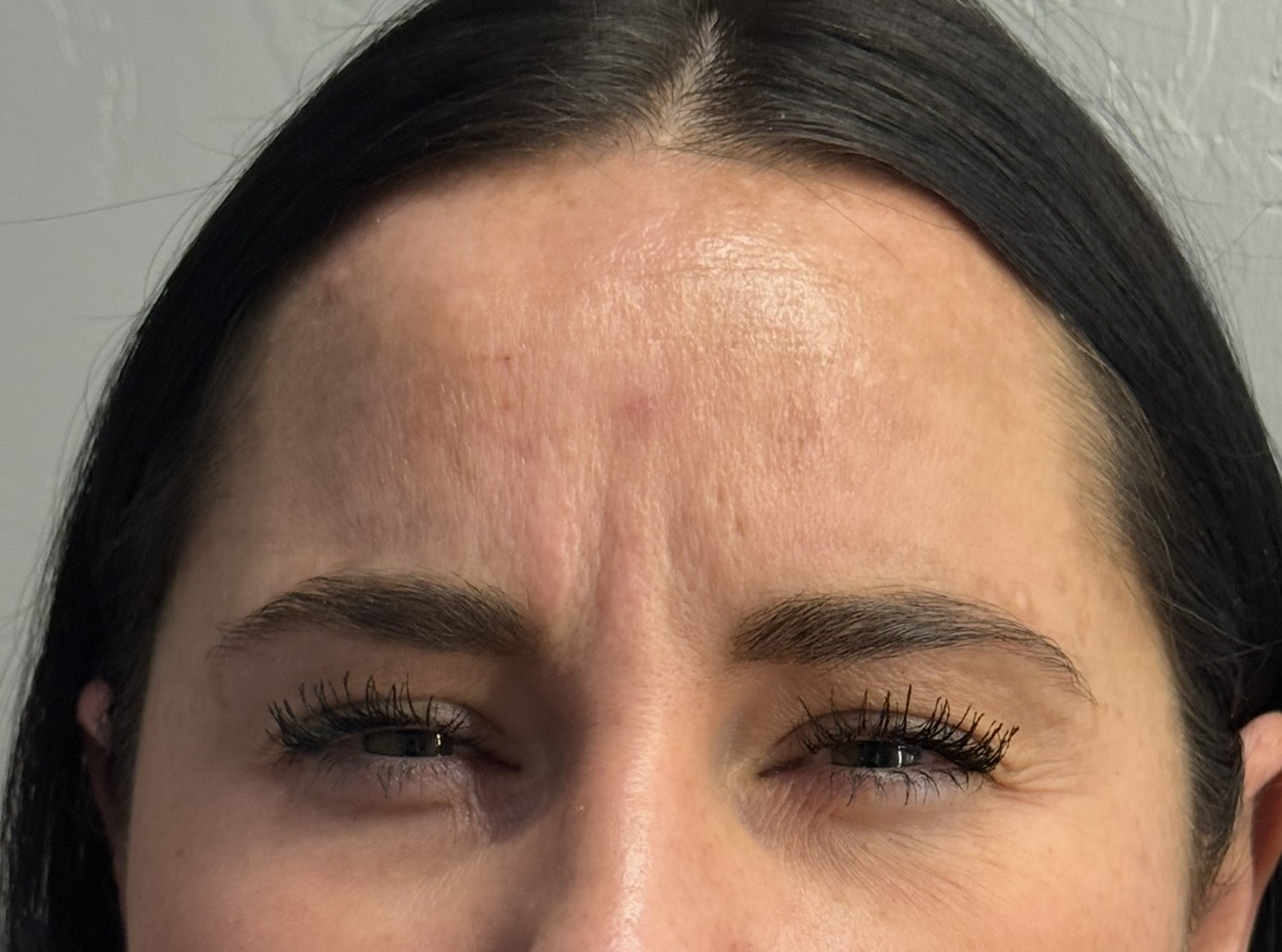 Before — lip enhancement