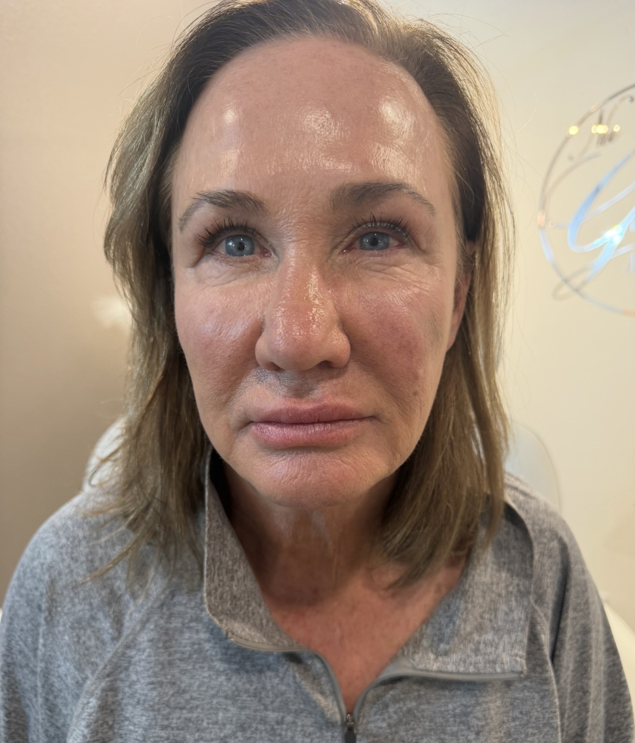 Dermal Filler after — case 1